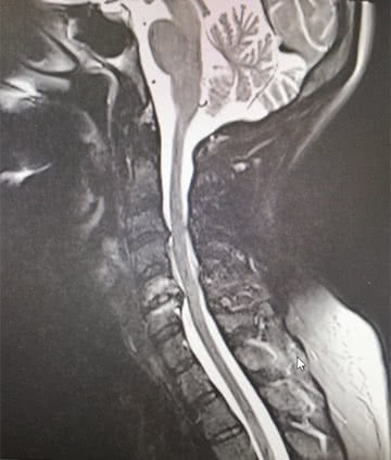 Radiografía de una Mielopatía Cervical
